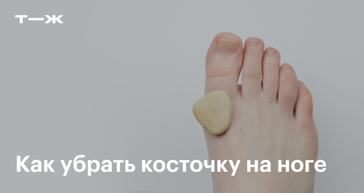 Лечение «Шишки» на большом пальце стопы или вальгусная деформация.