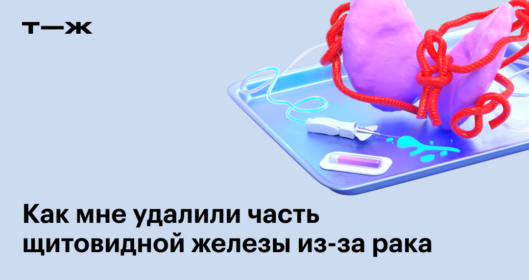 Как мне удалили папиллярный рак щитовидной железы
