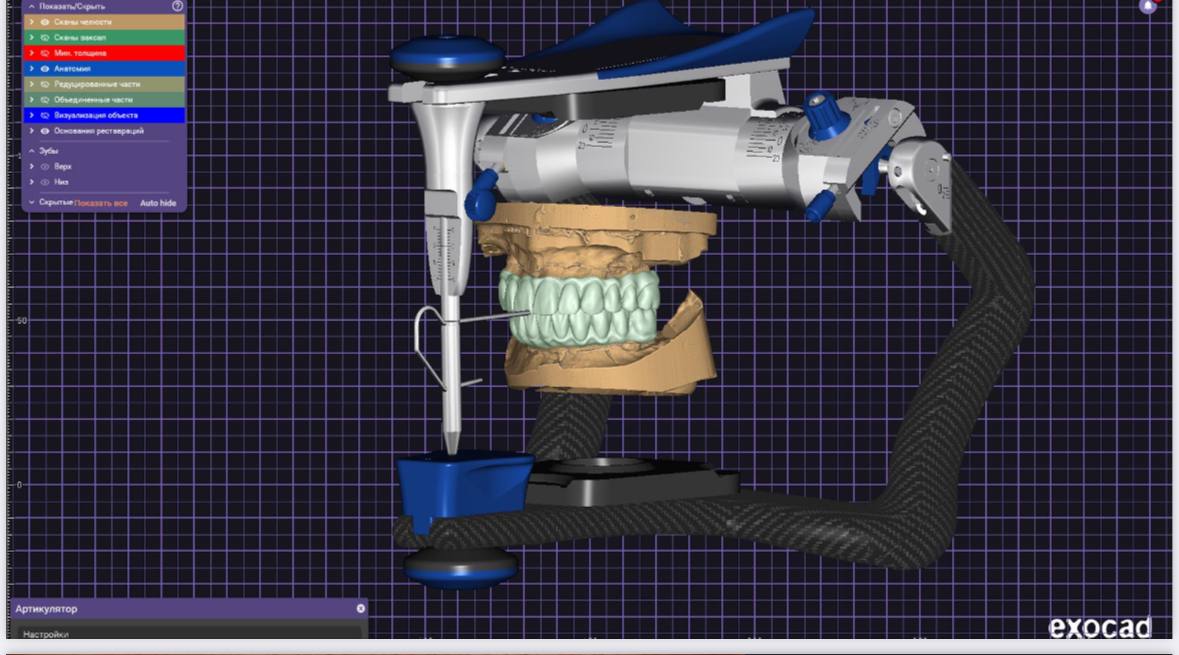 Цифровое моделирование позволяет точно выстроить прикус и определить положение будущих реставраций с высокой точностью