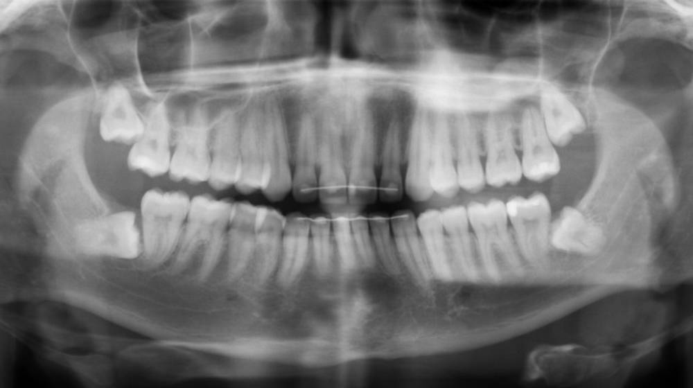 Так выглядят ретинированные зубы мудрости на специальном рентгеновском снимке — видно, что они находятся внутри десны, прорезались не полностью и под&nbsp;неправильным углом. Источник: radiopaedia.org