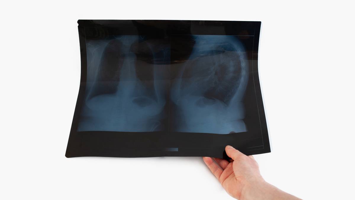 Пневмония: симптомы воспаления легких, как лечить и может ли пройти ...