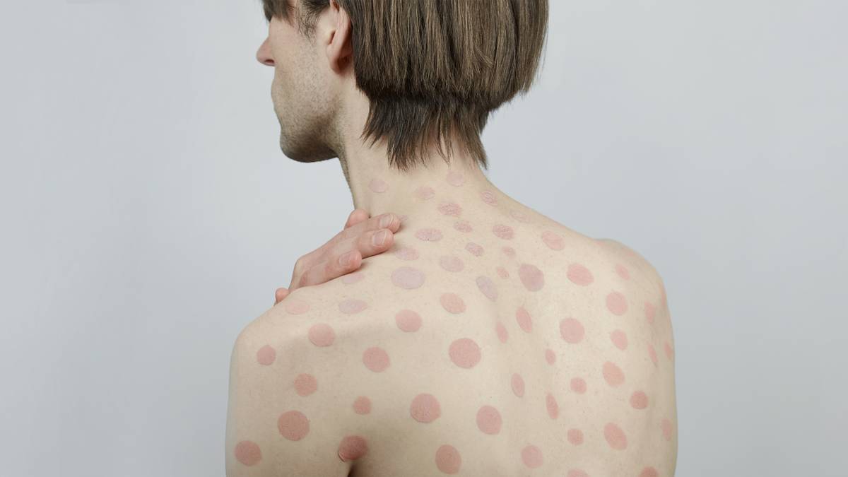 Что такое пигментная крапивница