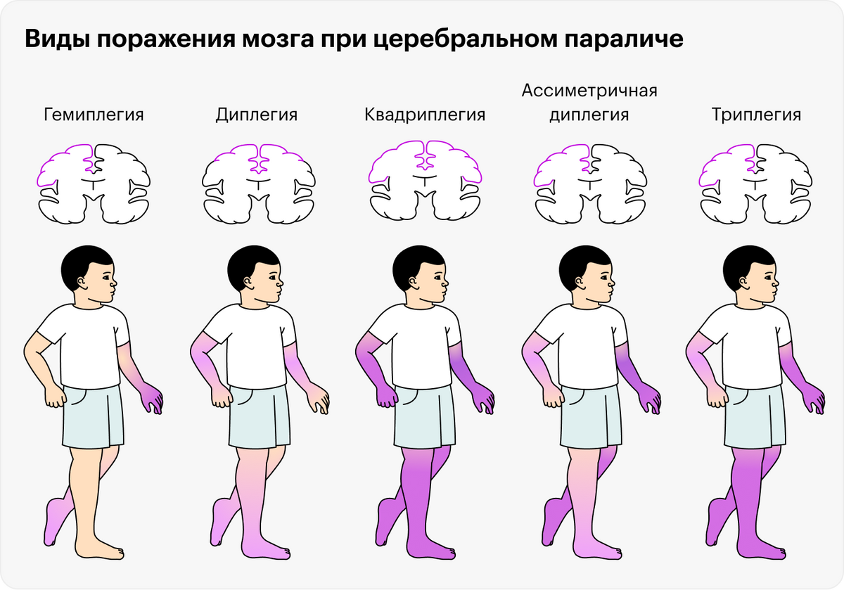 Церебральный паралич проявляется по-разному, в зависимости от того, какой участок мозга поражен и насколько сильно: от гемиплегии, когда движения нарушены в руке и ноге с одной стороны, до квадриплегии, когда человеку с трудом управляет обеими руками и ногами