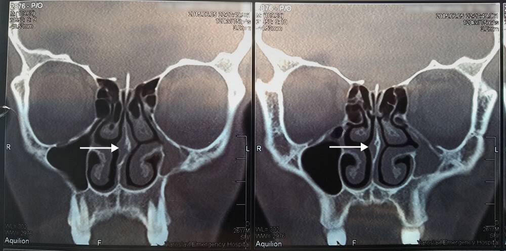 Искривление носовой перегородки: исправление операцией, стоимость и ...