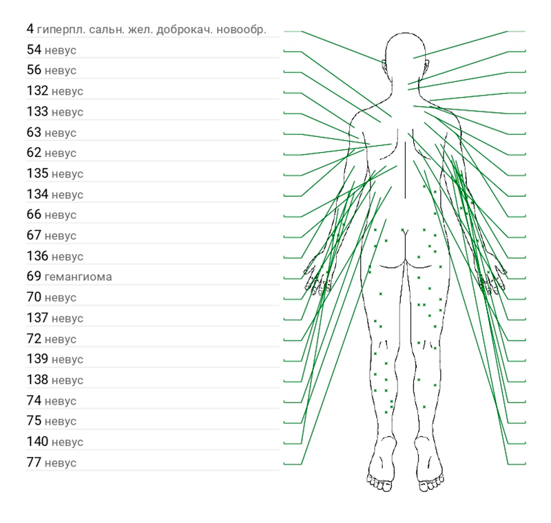Стоит ли удалять невус Ядассона?