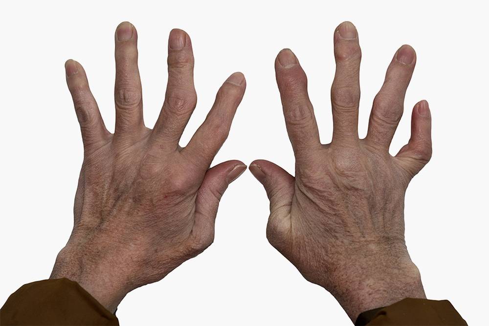 При&nbsp;ревматоидном артрите часто поражаются кисти, со временем суставы могут деформироваться. Источник: Gabdrakipova Dilyara / Shutterstock