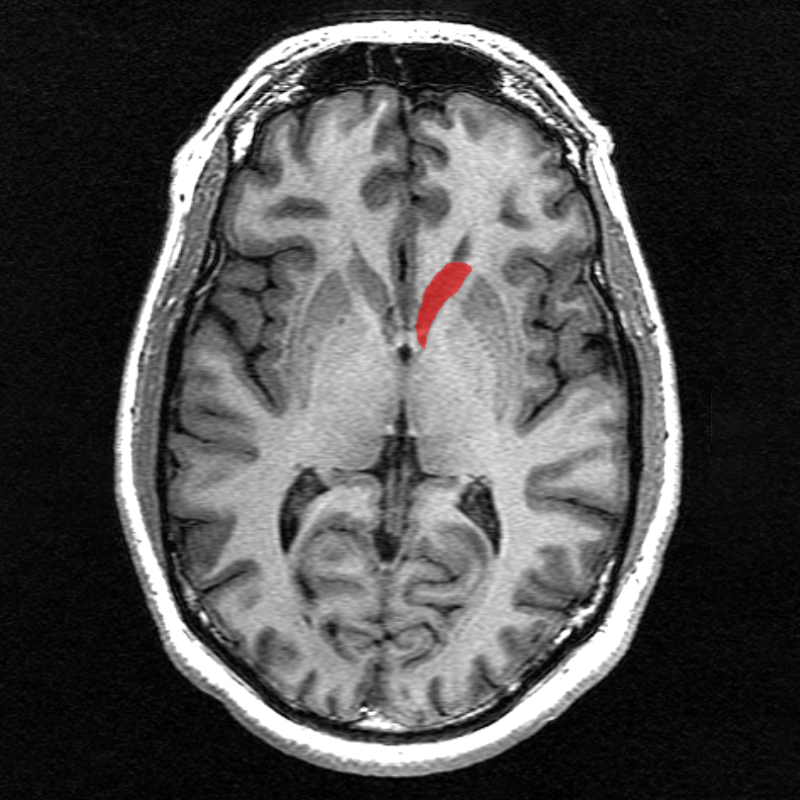 Скан мозга. Левое хвостатое ядро расположено в левом полушарии мозга, рядом с таламусом, и выделено красным цветом. Источник: wikipedia.org