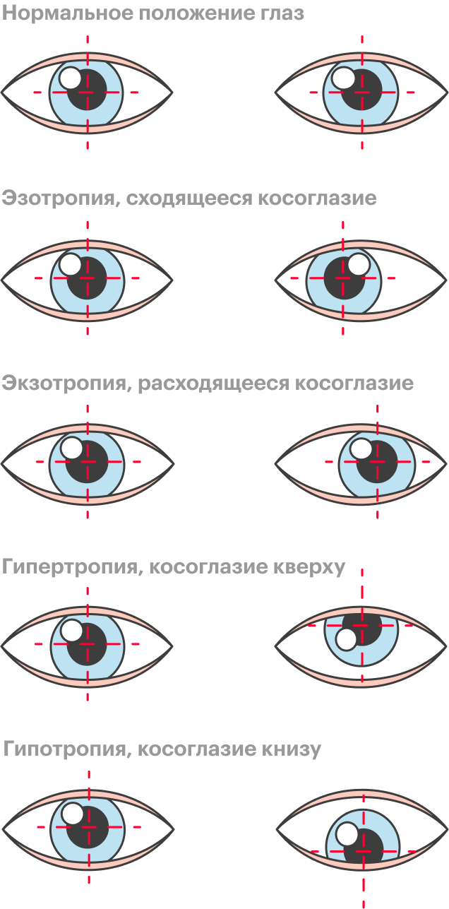 Глаза в разные стороны фото