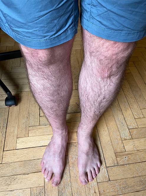 Спустя два с половиной года после травмы и операции ноги выглядят и функционируют совершенно одинаково