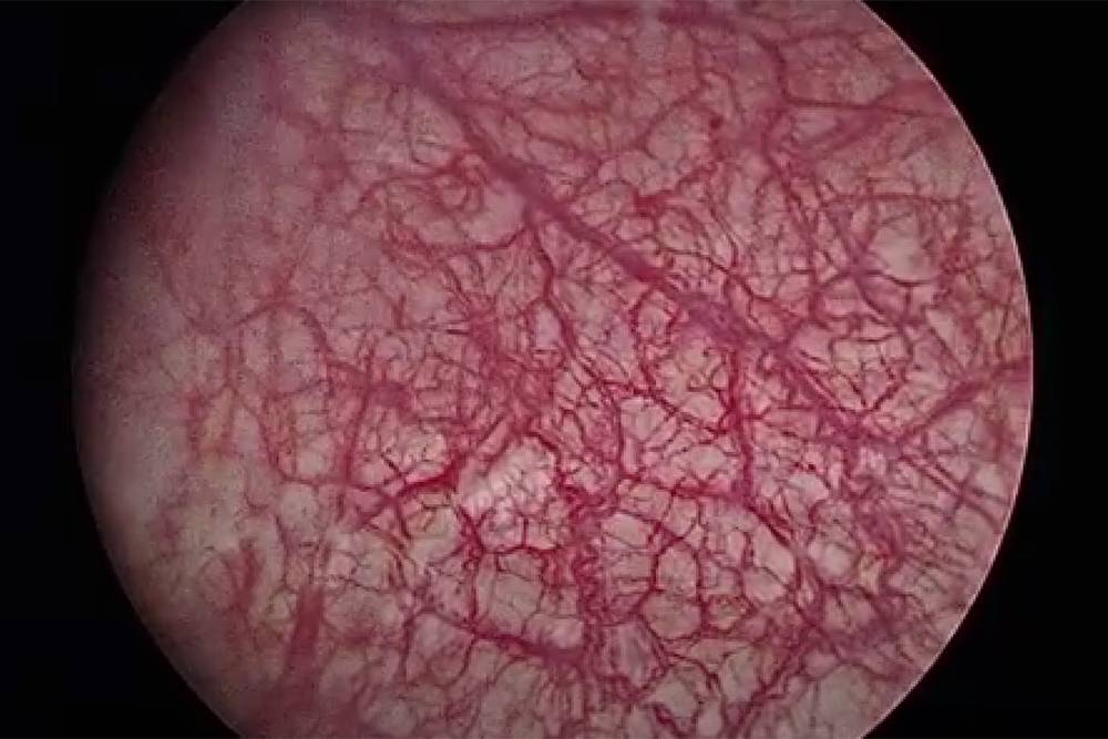 Чем опасен хронический цистит