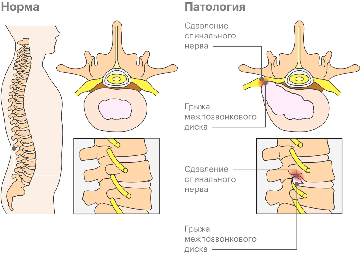 Межпозвонковые корешки