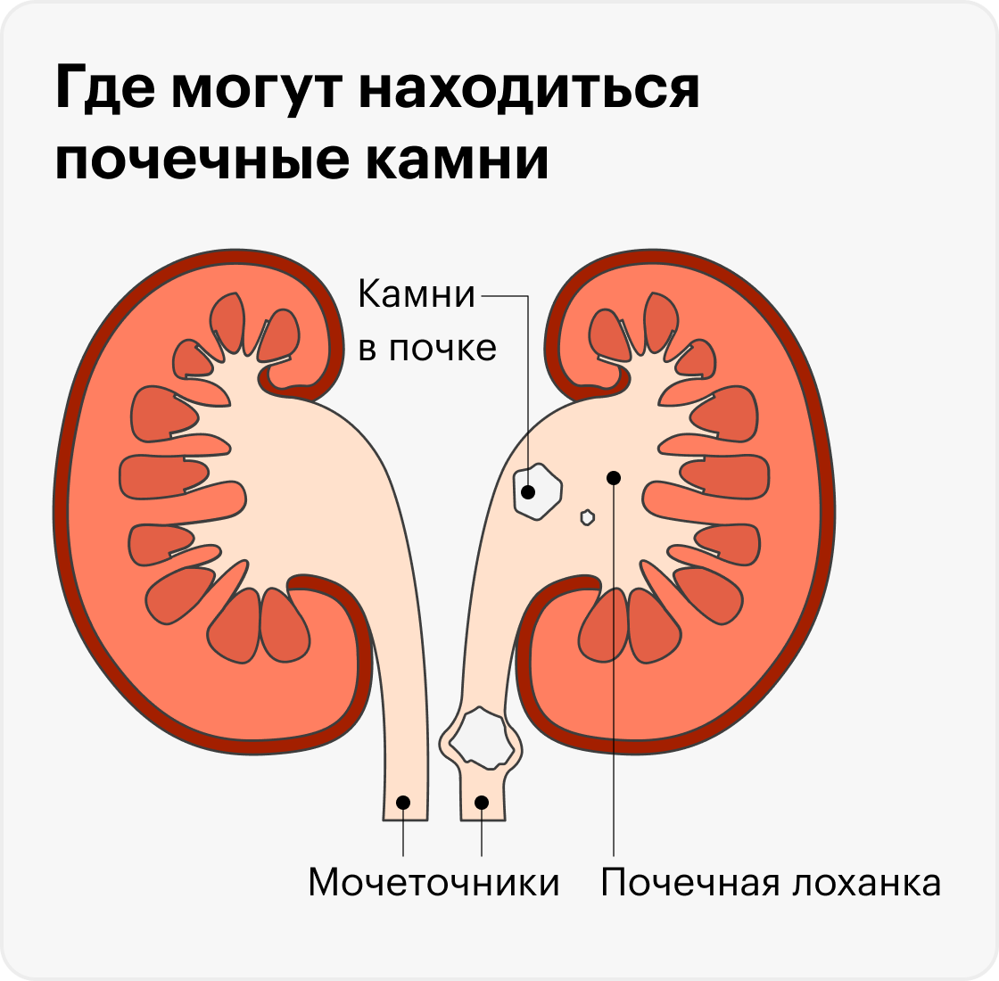 Боли при выходе песка из почек. Как избавиться от камней в почках. Где образуются камни в почках.