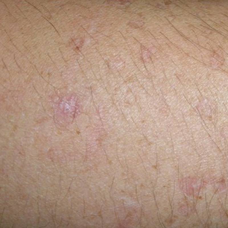 Как выглядит рак кожи и как его лечат