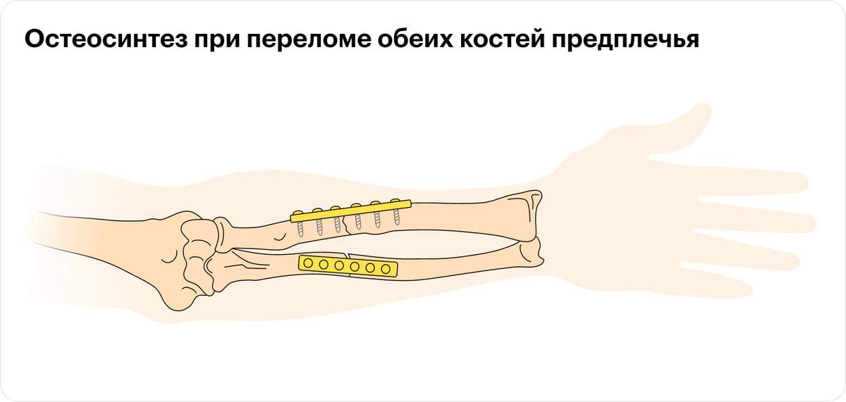 Остеосинтез при&nbsp;переломе обеих костей предплечья