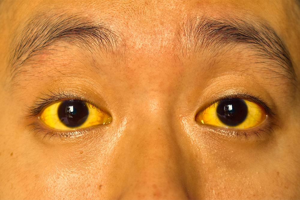 Пожелтение кожи и белков глаз при&nbsp;остром поражении печени. Источник: Zay&nbsp;Nyi&nbsp;Nyi / Shutterstock