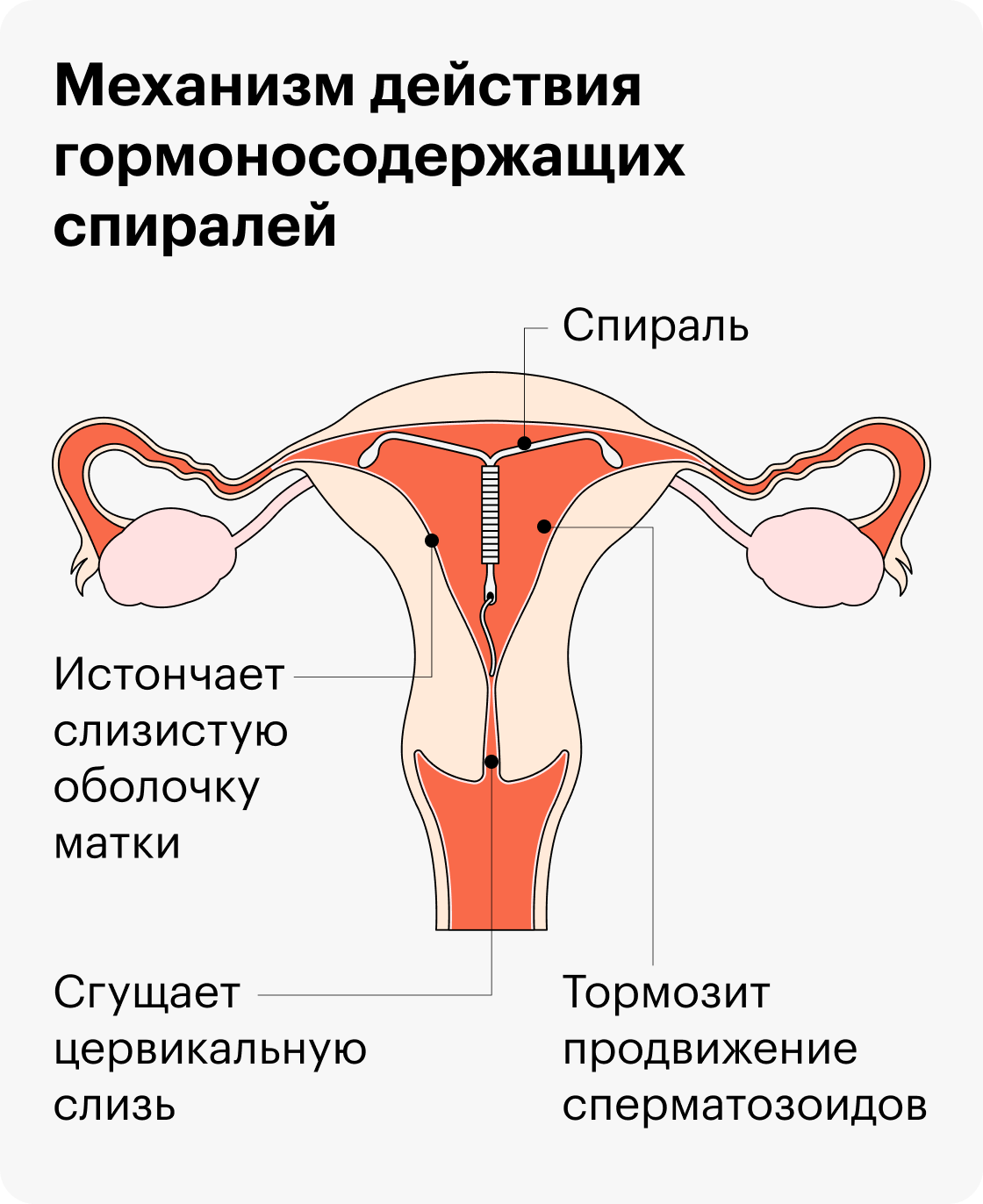 Внутриматочная спираль: сколько стоит установка, когда можно ставить ...