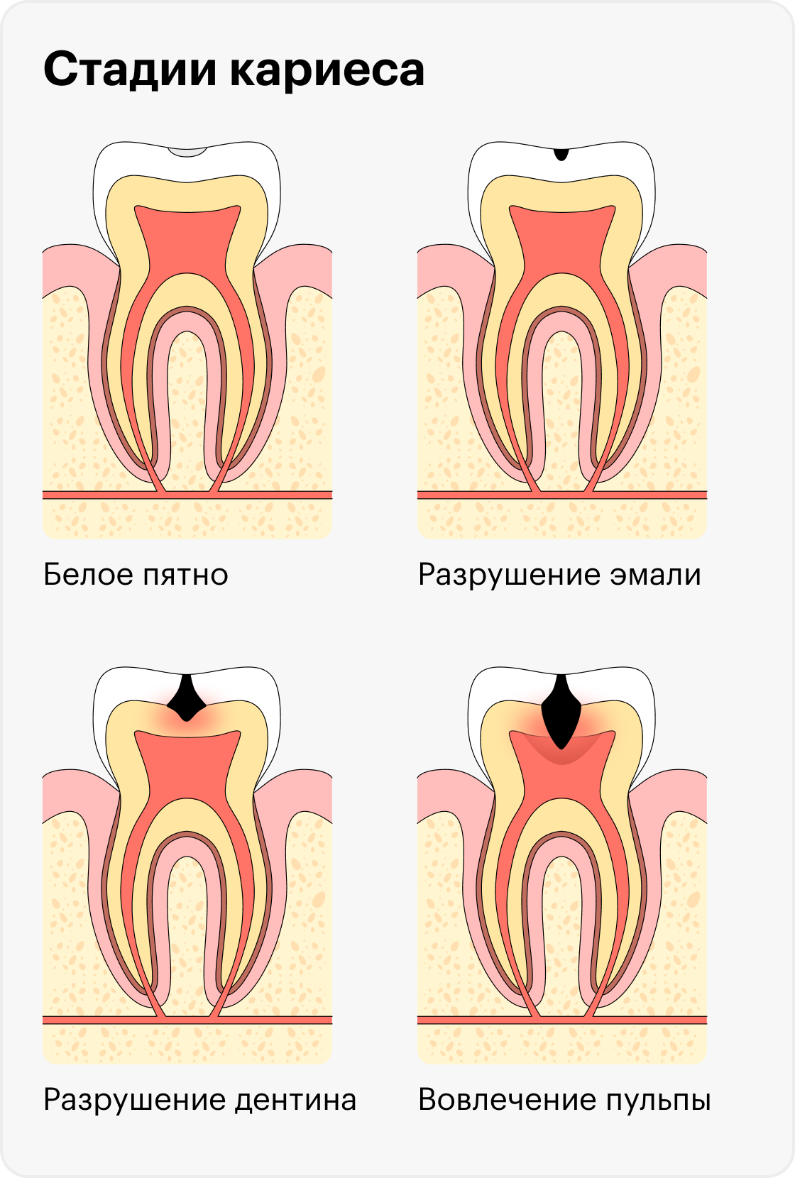 Разрушение зуба при&nbsp;кариесе начинается с крохотного белого пятнышка на эмали и заканчивается пульпитом