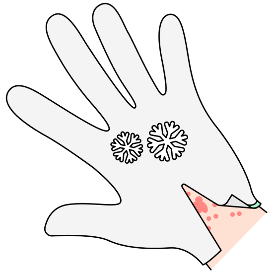 Аллергия на холод: как проявляется и выглядит холодовая крапивница ...