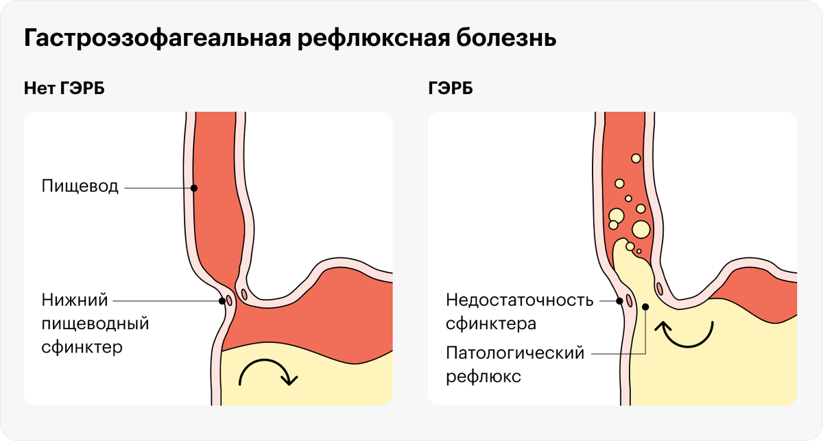 Как приподнять изголовье кровати при рефлюксе