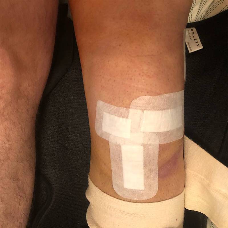 Вот так колено выглядело после операции, когда сняли дренаж