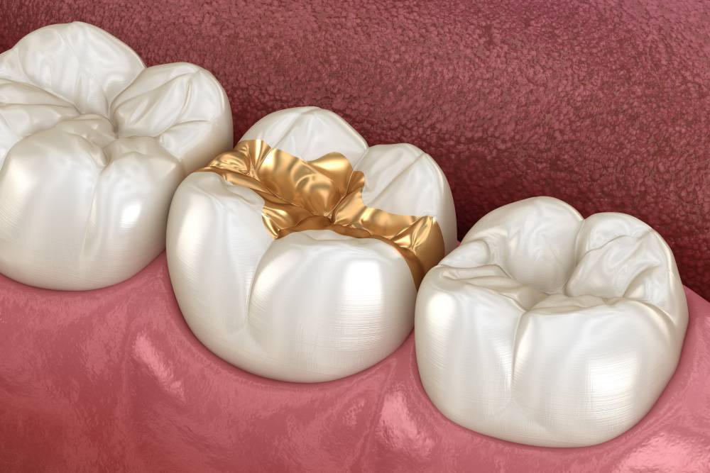 Золотая пломба в зубе. Источник:&nbsp;Alex Mit / Shutterstock