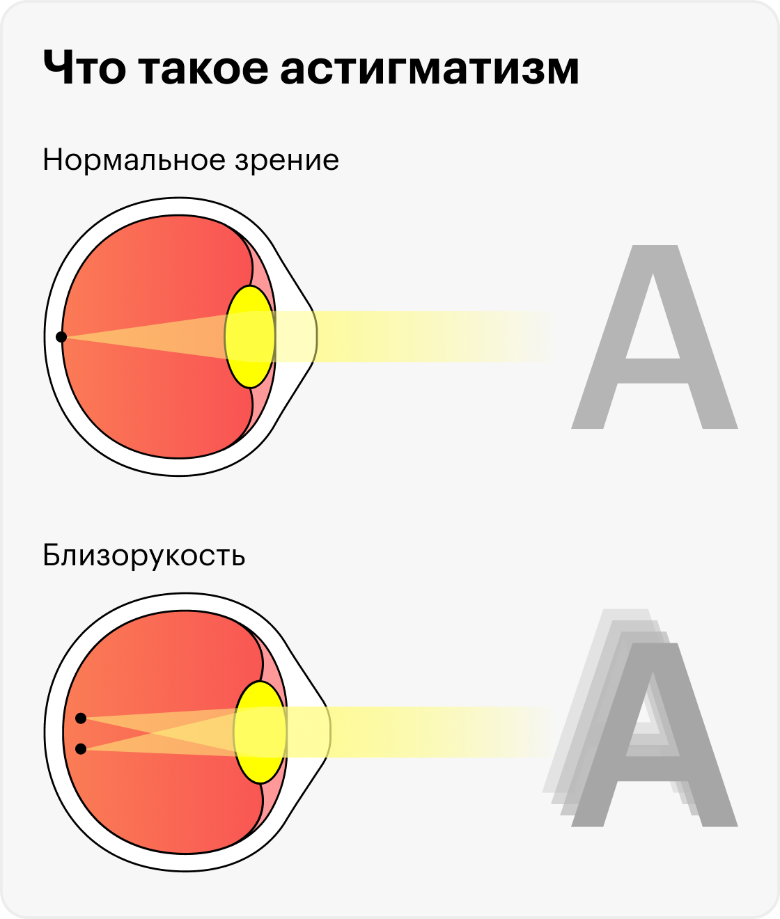 Гиперметропический астигматизм. Сложный гиперметропический астигматизм обоих глаз. Гиперметропический астигматизм у детей. Гиперметропический астигматизм обратного типа.