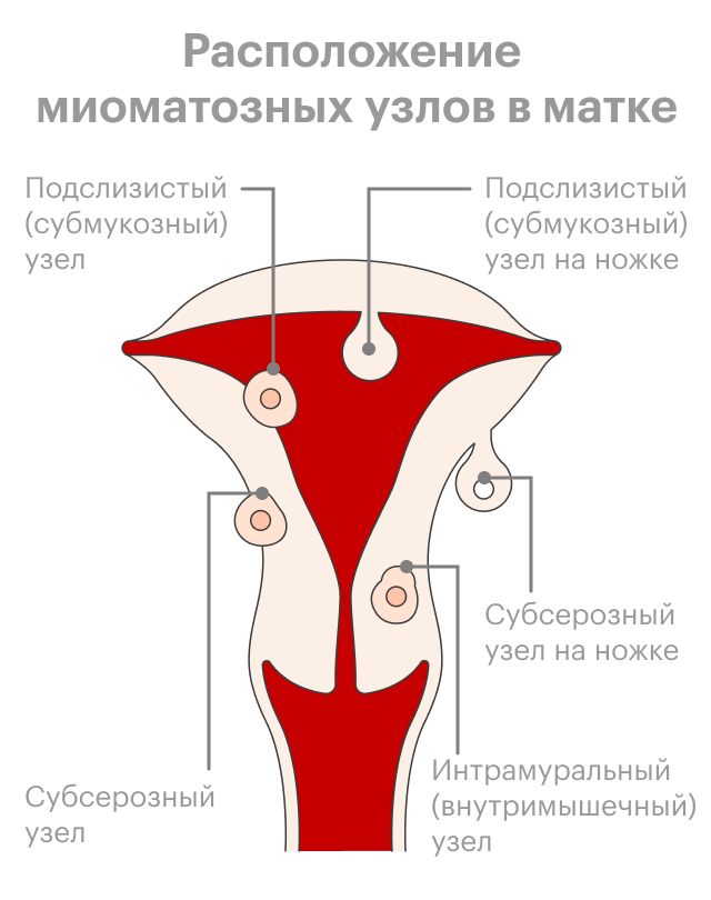 Схема расположения миоматозных узлов в&nbsp;матке