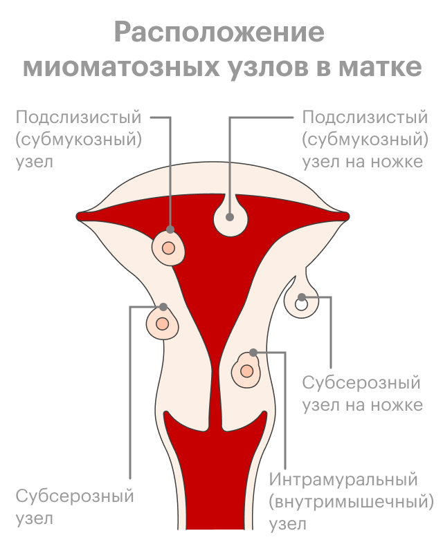 Миоматозный узел рождающийся фото