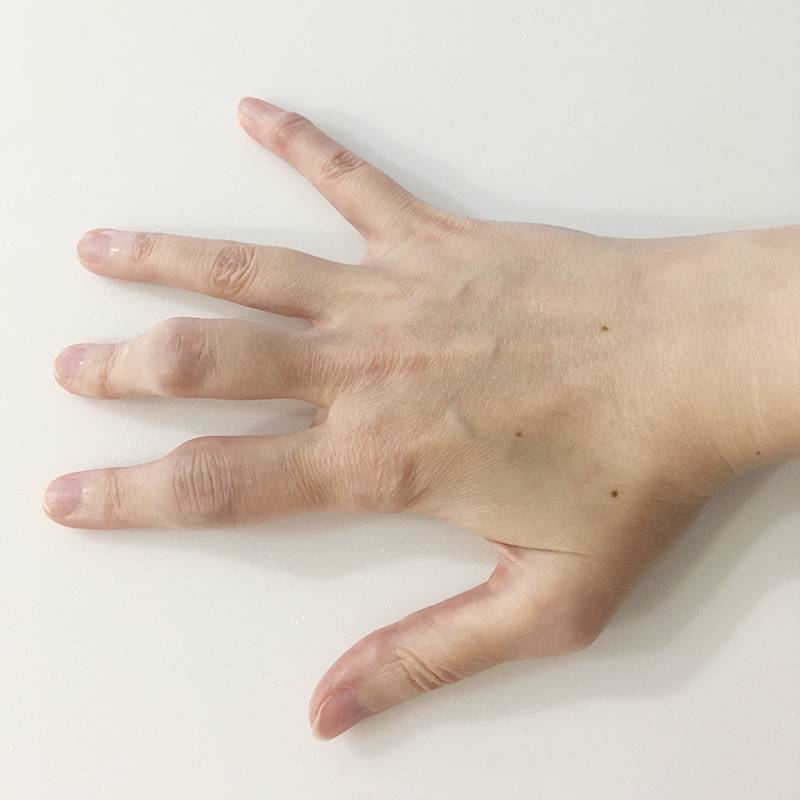Так выглядели мои пальцы в 2014&nbsp;году. Сейчас в обострения они еще припухают и чуть краснеют, а средний палец сильнее деформировался. Но при&nbsp;любом лечении в норму они не возвращаются
