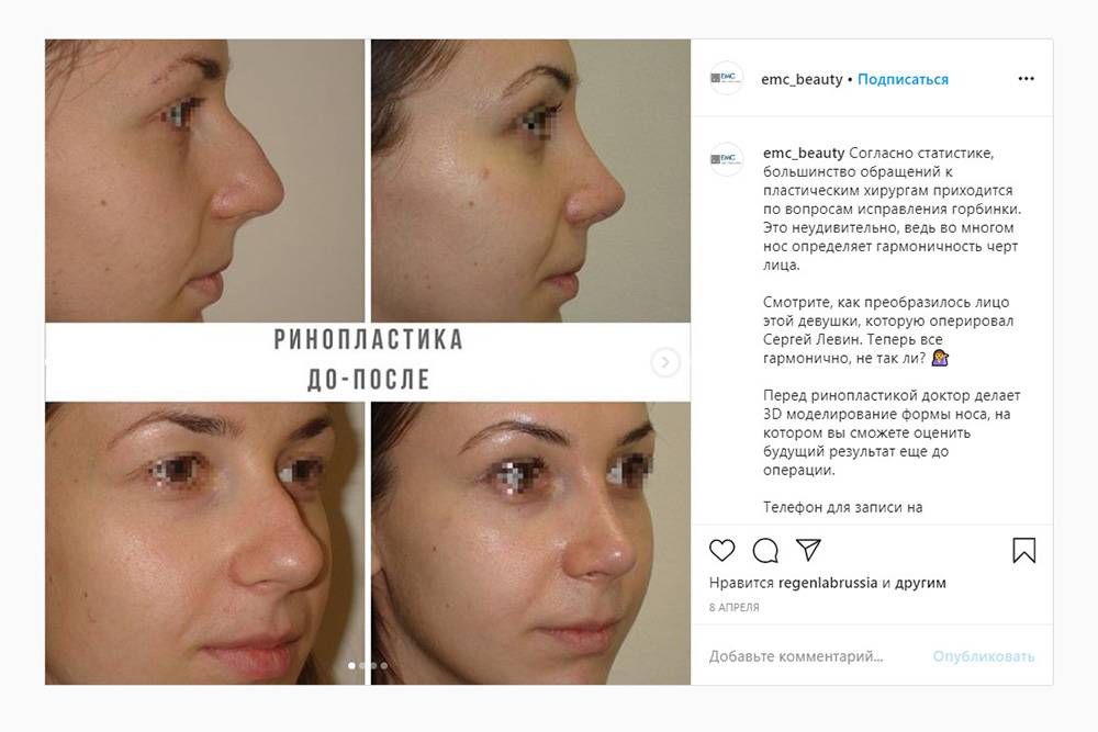 Пример ринопластики с исправлением горбинки носа. Источник: emc_beauty / Instagram