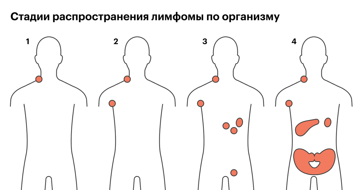 Oepa лимфома схема