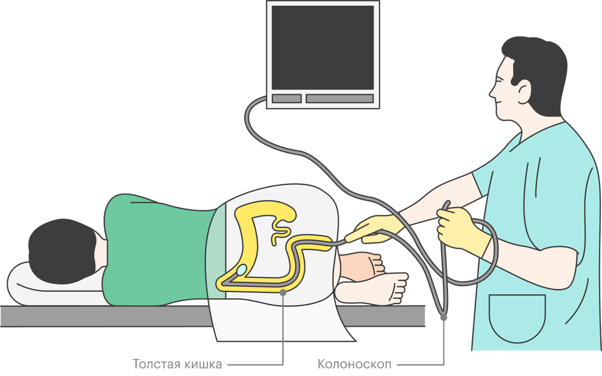 Колоноскопия в картинках