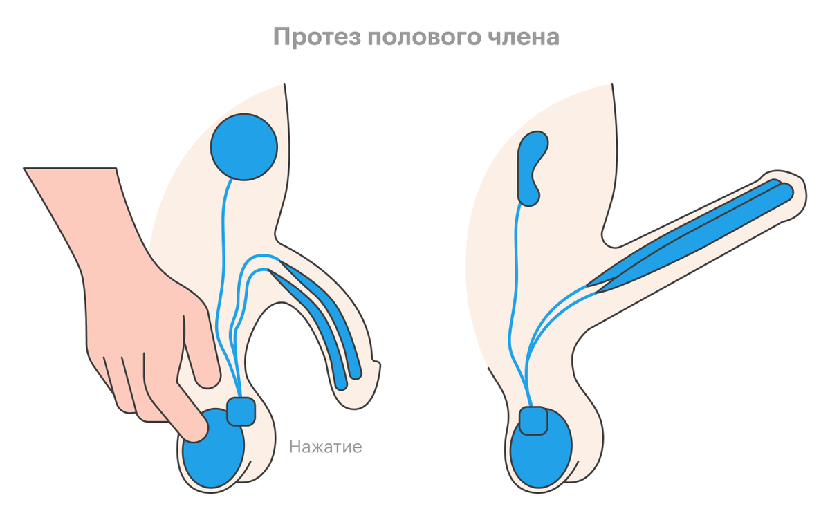 протез для мужского члена фото 68