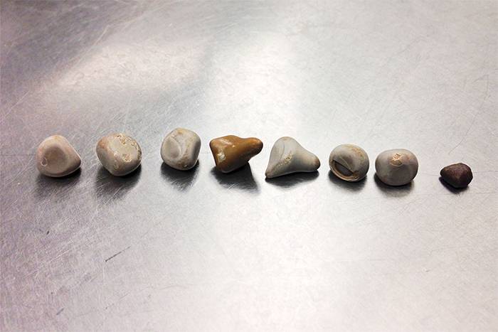 Почечные камни разного размера. Источник: kidneystoners.org