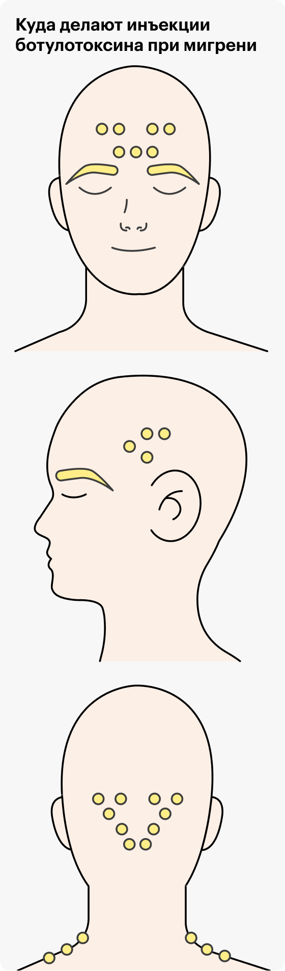 При&nbsp;мигрени инъекции ботулотоксина делают в точки в разных частях головы