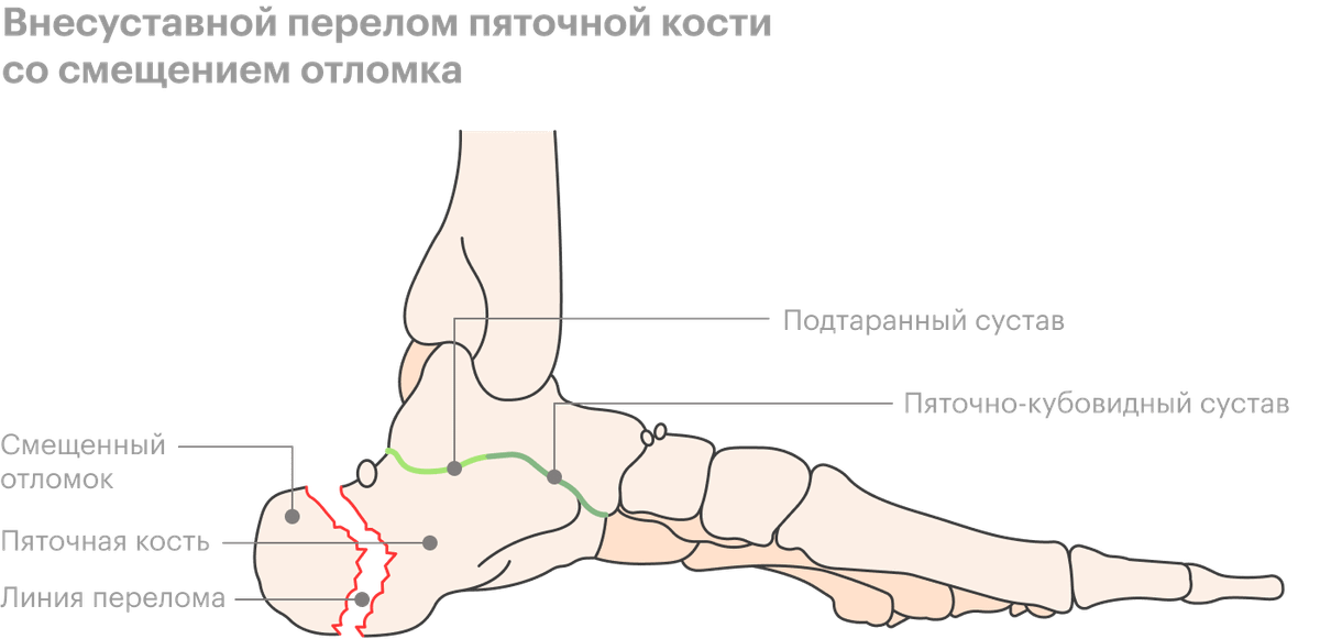 Закрытый перелом пяточной кости карта вызова