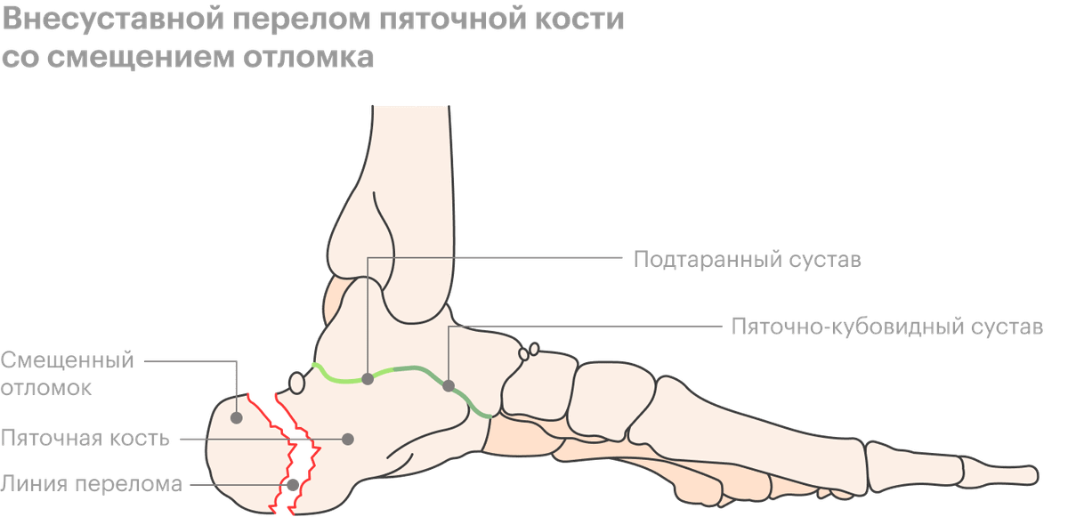 Задний отросток таранной кости