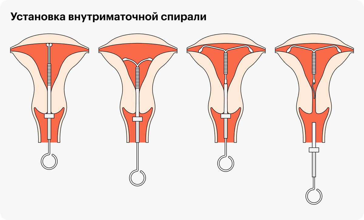 Спираль внутриматочная фото в матке