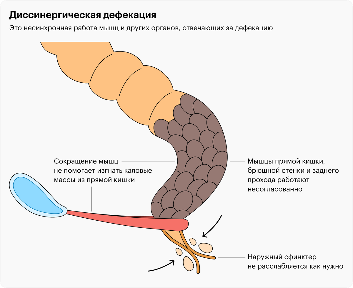 Дефекация после операции. Процесс дефекации человека. Дефекация прямой кишки.