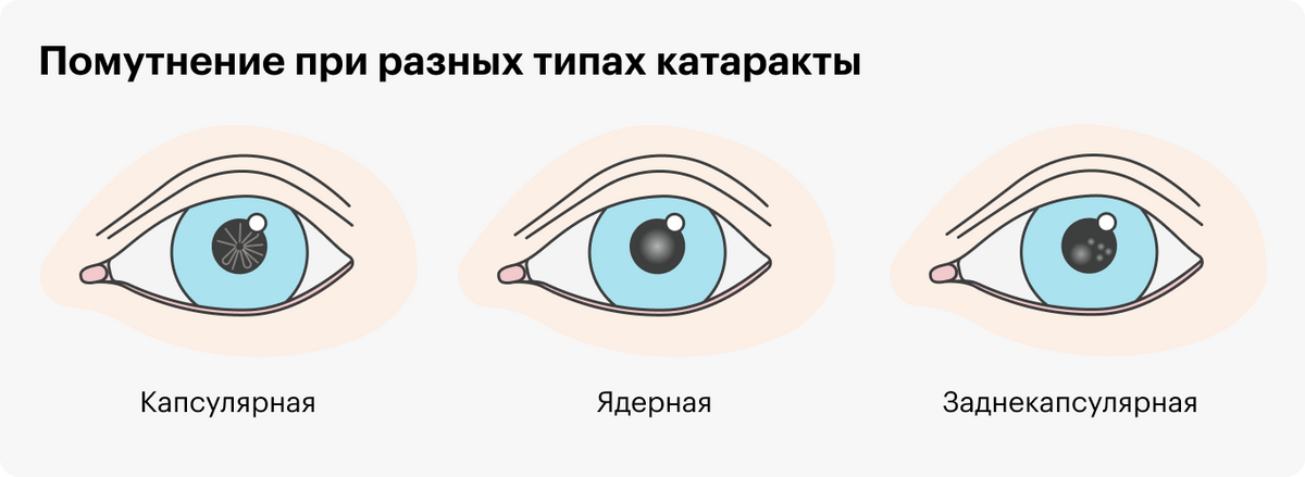 Помутнение при разных типах катаракты будет выглядеть по-разному: при капсулярной оно напоминает расходящиеся лучи, при ядерной располагается в центре зрачка, при заднекапсулярной смещено от центра зрачка