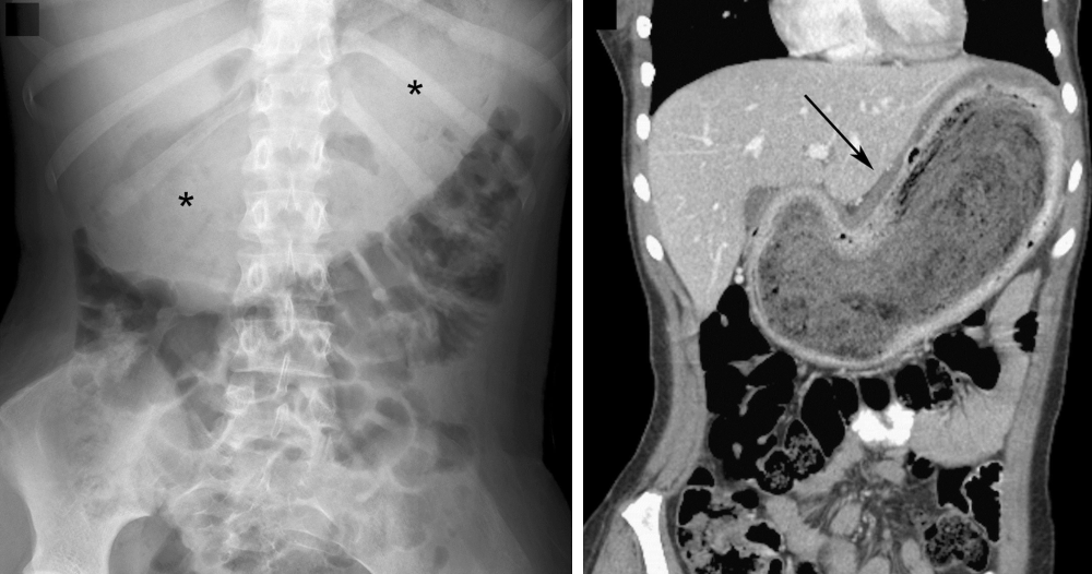 На рентгене слева и компьютерной томографии справа видны безоары, но рассмотреть их там может только опытный врач. Источник: MSD
