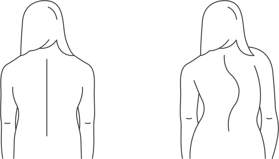 Искривление спины при&nbsp;сколиозе обычно хорошо заметно. Если поставить ребенка на ровный пол возле однотонной стены, будет видно асимметричное расположение плеч, лопаток и углов талии