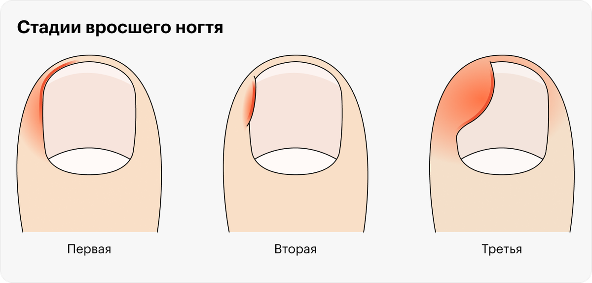 Обработка вросшего ногтя схема