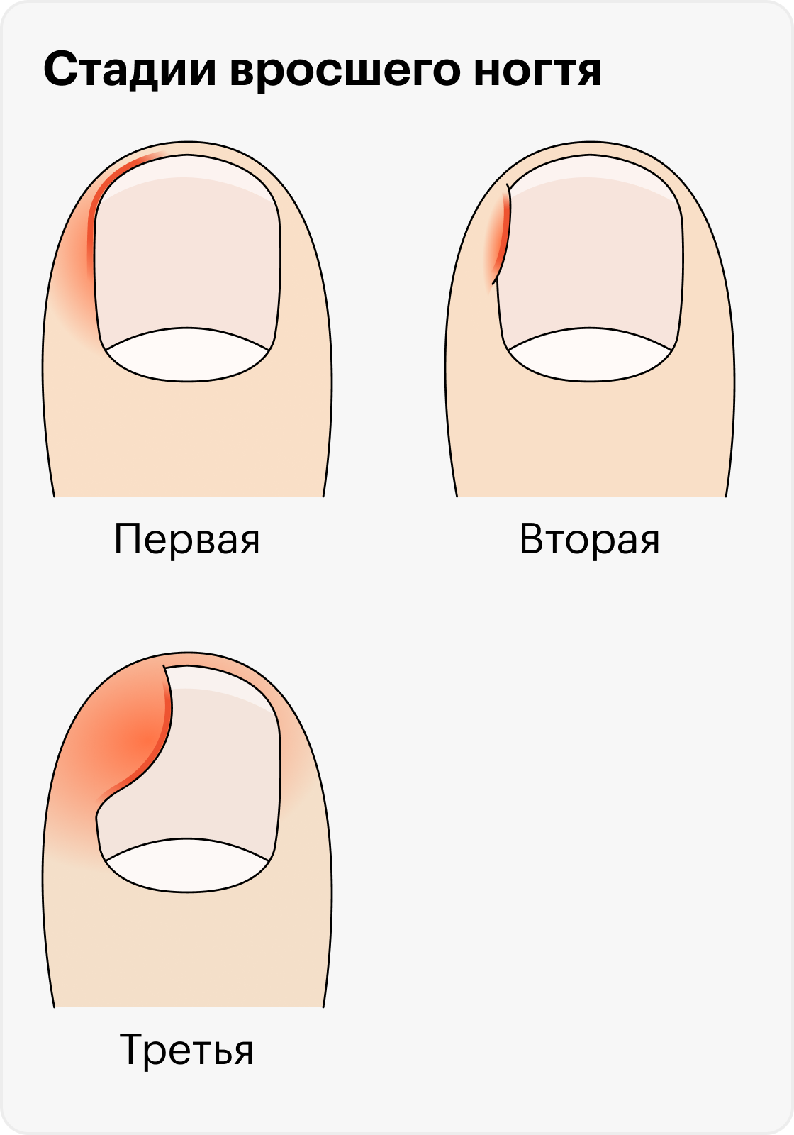 Обработка вросшего ногтя схема