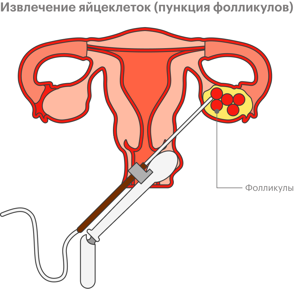 Пункция яйцеклеток при эко. Пункция фолликулов кровотечение. Боли после пункции фолликулов