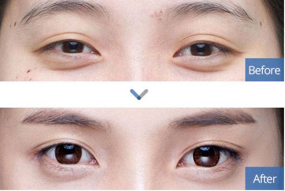 Одна из самых популярных процедур — изменение формы глаз