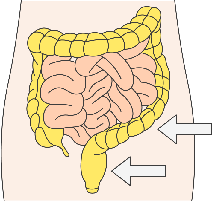 Полипы толстой кишки в основном находят в прямой и сигмовидной кишках — двух самых близких к анусу отделах