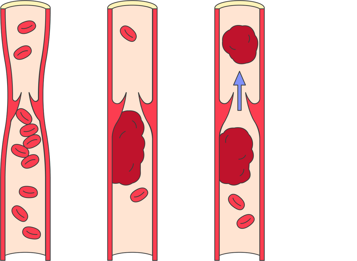 Опасность тромбоза вен в&nbsp;том, что тромб может оторваться и&nbsp;вызвать такое грозное осложнение, как ТЭЛА — тромбоэмболию легочной артерии, то&nbsp;есть ее закупорку тромбом