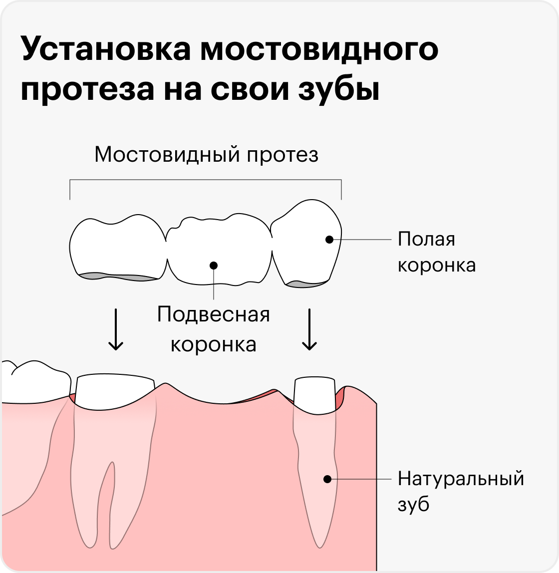 Так выглядит мостовидный протез. Зубы, которые находятся рядом с утраченным, соединяются протезирующей конструкцией, то есть шинируются