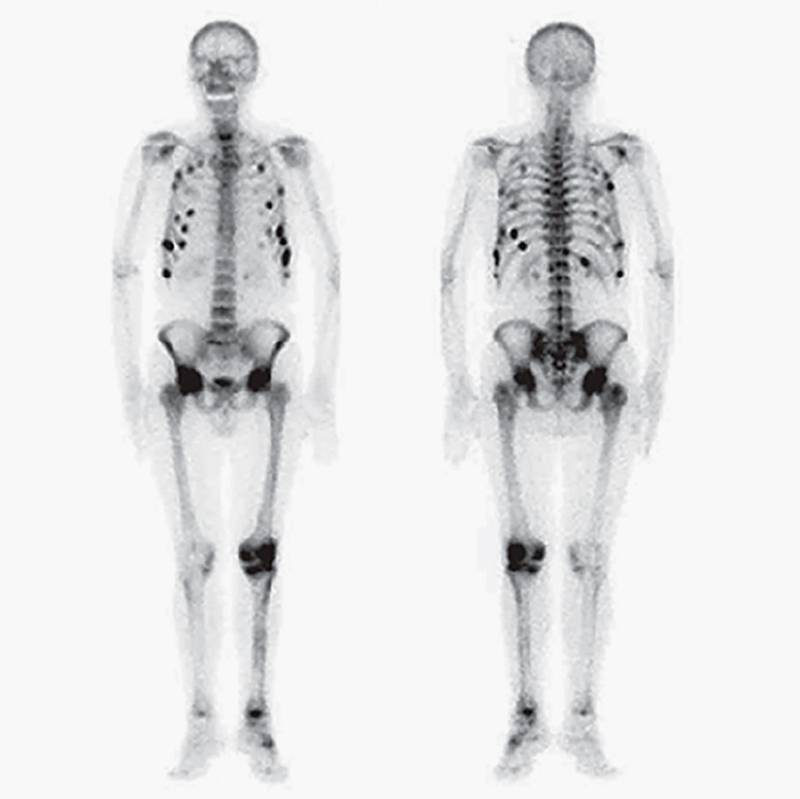 На этой остеосцинтиграфии видны изменения в костях. Но это не рак, а множественные стрессовые переломы. Источник: researchgate.net